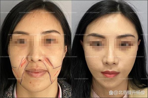 面部提升术能保持多久_面部提升术多少钱