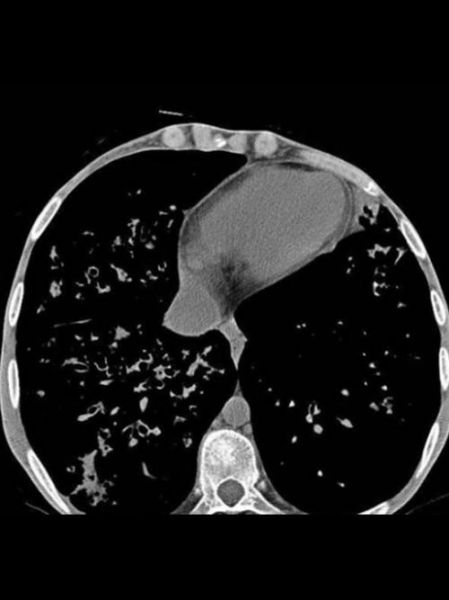 囊性纤维化能治好吗_囊性纤维化最新治疗进展